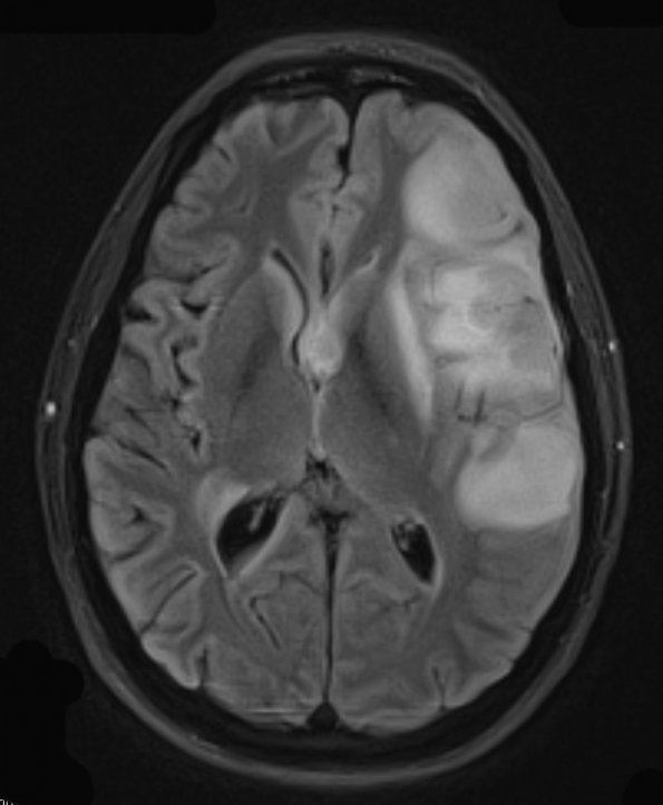 1A1 Lymphoma, large B cell (Case 1) TIRM - Copy - Copy