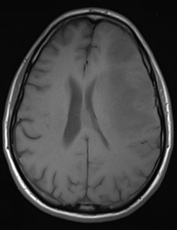 1A2 Lymphoma, large B cell (Case 1) T1 1 - Copy - Copy