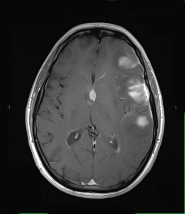 1A3 Lymphoma, large B cell (Case 1) T1 W 6 - Copy - Copy