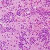 1B1 Lymphoma, B cell (Case 1) H&E 9.jpg