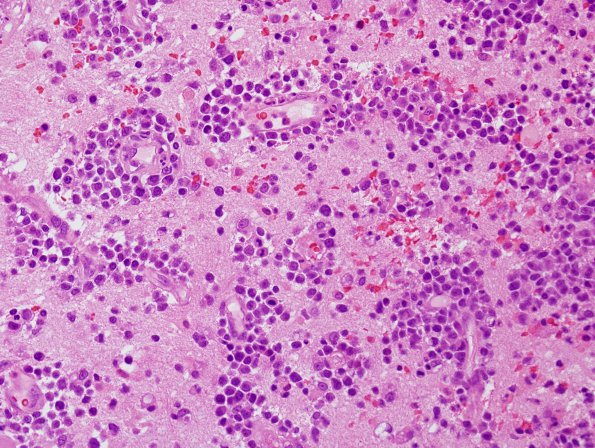 1B1 Lymphoma, B cell (Case 1) H&E 9.jpg