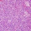 1B2 Lymphoma, B cell (Case 1) H&E 1.jpg