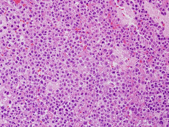 1B2 Lymphoma, B cell (Case 1) H&E 1.jpg