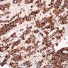 1C Lymphoma, B cell (Case 1) CD20 1.jpg