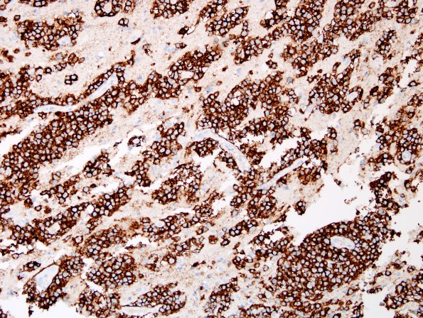 1C Lymphoma, B cell (Case 1) CD20 1.jpg