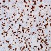 1D Lymphoma, B cell (Case 1) CD3 1.jpg