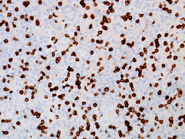 1D Lymphoma, B cell (Case 1) CD3 1.jpg