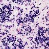 1E1 Lymphoma, B cell (Case 1) EBER ISH 2.jpg