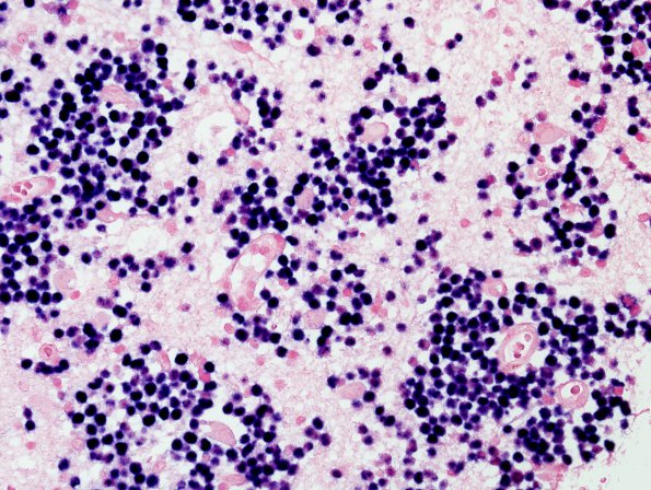 1E1 Lymphoma, B cell (Case 1) EBER ISH 2.jpg