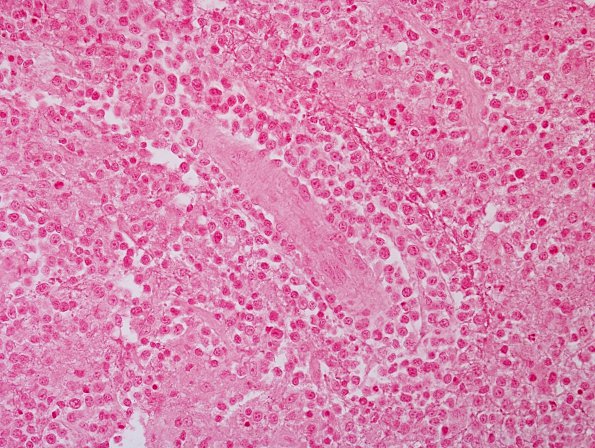 1E2 Lymphoma, B cell (Case 1) ISH NEG 1.jpg