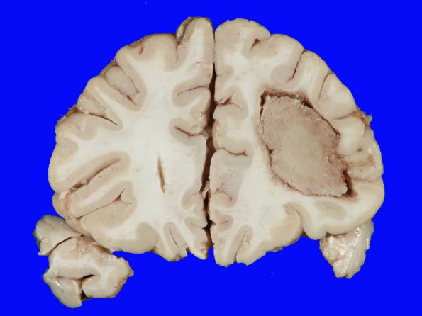 2A1 Lymphoma, AIDS (Case 2) gross_1