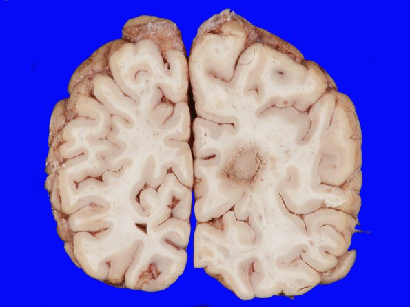 2A3 Lymphoma, AIDS (Case 2) gross_9