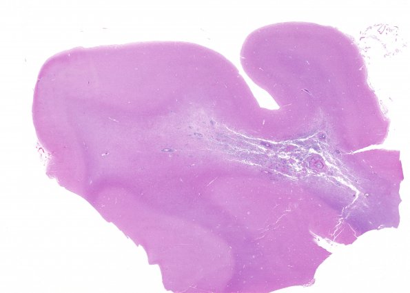 2B2 Lymphoma, AIDS (Case 2) H&E whole mount