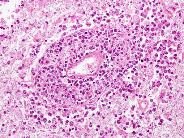 2B3 Lymphoma, AIDS (Case 2) H&E 1