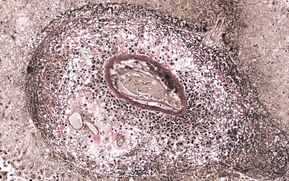 2B7 Lymphoma, AIDS (Case 2) VVG