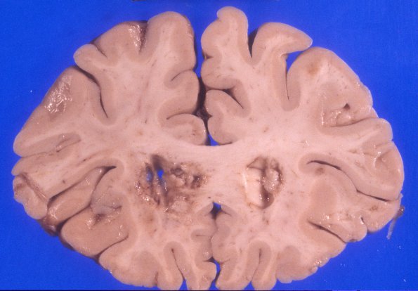 3A1 Lymphoma, primary, AIDS, multiple (Case 3) 6