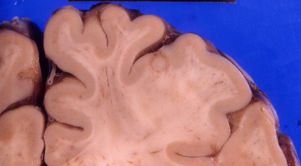 3A4 Lymphoma, primary, AIDS, multiple (Case 3) 5