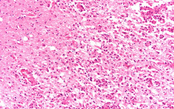 3B2 Lymphoma, primary, AIDS, multiple (Case 3) N18 H&E 20X