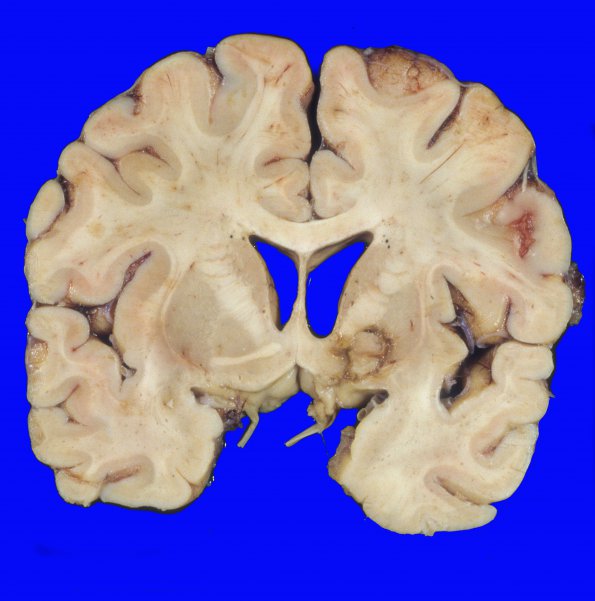 4A1 Encephalitis HIV, Vacuolar Myelopathy, Lymphoma (Case 4) 1