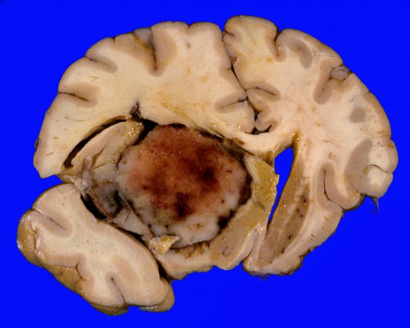 5A1 Lymphoma (Case 5) gross 1