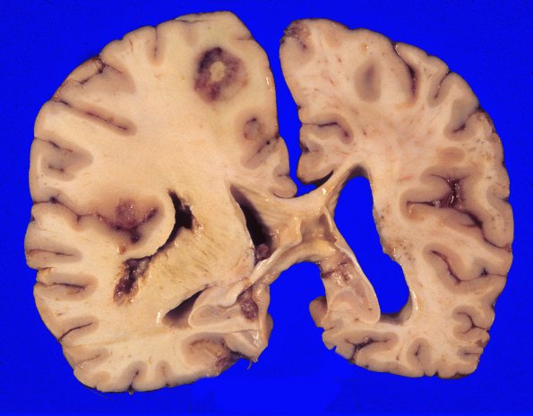 5A2 Lymphoma (Case 5) gross 3