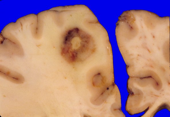 5A3 Lymphoma, HIV Leukoencephalopathy, CMV (Case 5) 3