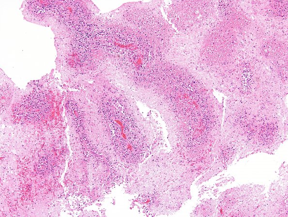 6B1 Lymphoma (Case 6) H&E 2