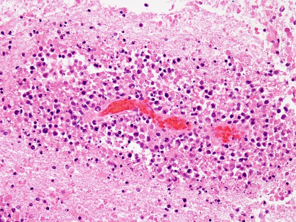 6B2 Lymphoma (Case 6) H&E 1