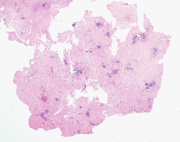 6E Lymphoma (Case 6) EBER 1