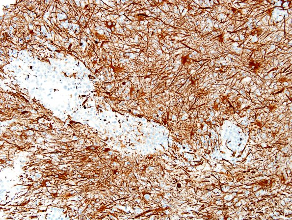 6F Lymphoma (Case 6) GFAP 1