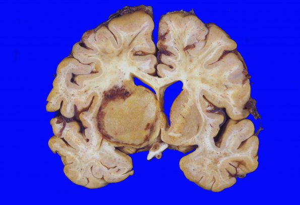 7A1 Lymphoma, HIV, CMV (Case 7)