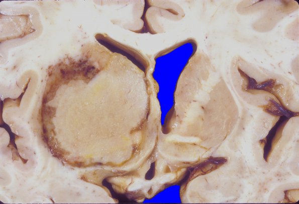 7A2 Lymphoma, HIV (Case 7) 3 (2)