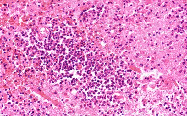 7B1 Lymphoma, HIV, CMV (Case 7) 40X