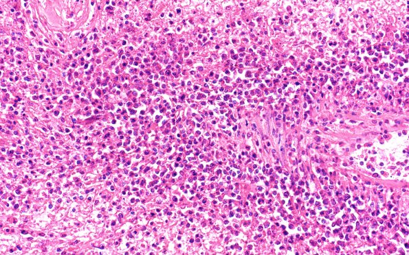 7B2 Lymphoma, HIV, CMV (Case 7) 40X 2