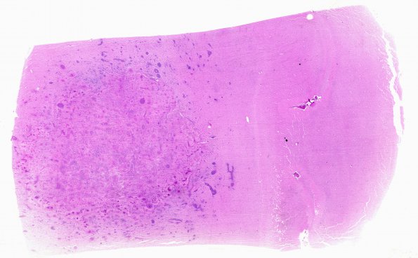 8B1 Lymphoma (Case 8) H&E WM