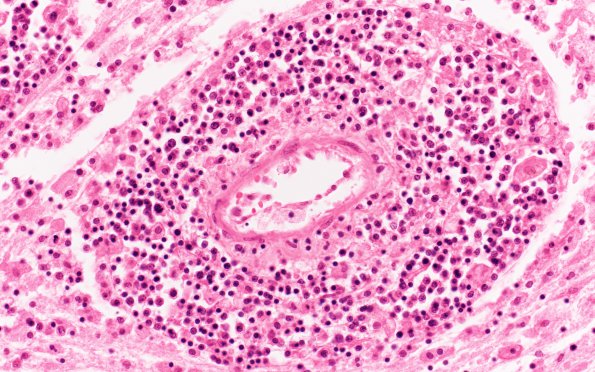 8B2 Lymphoma (Case 8) H&E 40X