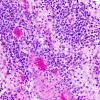 9A Lymphoma (Case 9) 2.jpg