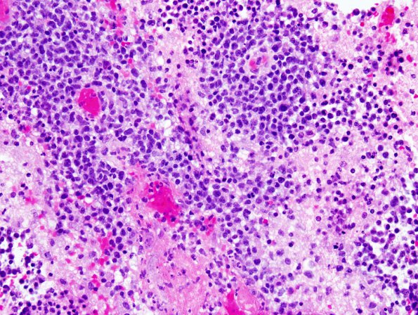 9A Lymphoma (Case 9) 2.jpg