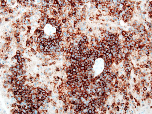 9B Lymphoma (Case 9) CD20 2.jpg