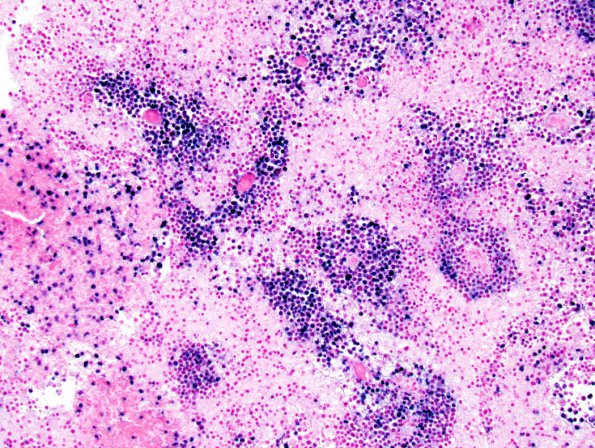 9C Lymphoma (Case 9) EBER 1.jpg