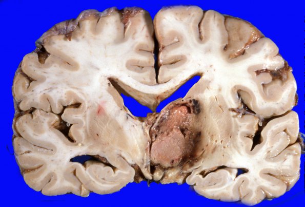 10A2 Lymphoma (Case 10) gross 1