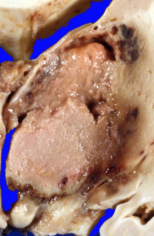 10A3 Lymphoma (Case 10) gross 2