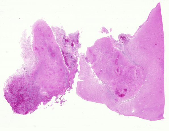 10B1 Lymphoma (Case 10) whole mount