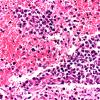 10B3 Lymphoma (Case 10) A 40X