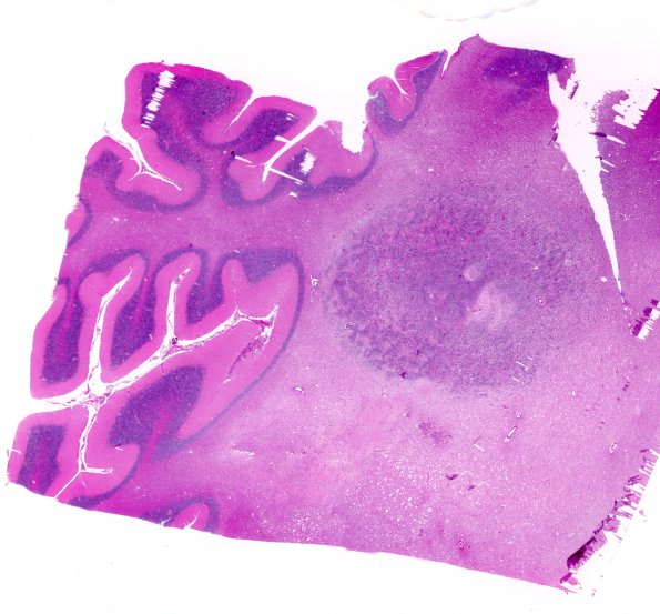 11A1 Lymphoma, DLCB, Anaplastic (Case 11) H&E WM