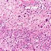 11A3 Lymphoma, DLCB, Anaplastic (Case 11) H&E 20X