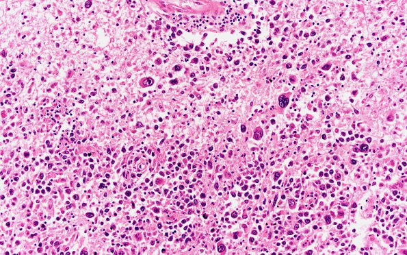 11A3 Lymphoma, DLCB, Anaplastic (Case 11) H&E 20X