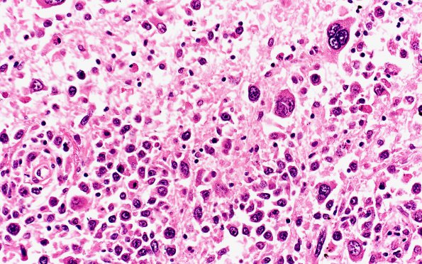 11A4 Lymphoma, DLCB, Anaplastic (Case 11) H&E 40X