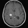 13A Lymphoma, primary CNS, B-cell (Case 13) T1W - Copy