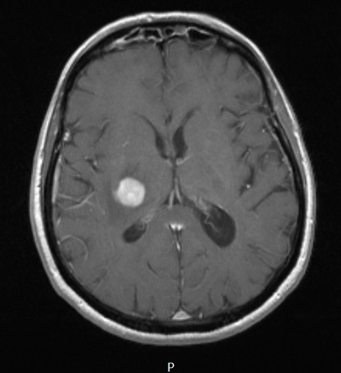 13A Lymphoma, primary CNS, B-cell (Case 13) T1W - Copy